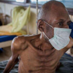 Effect of Covid-19 on Tuberculosis Treatment